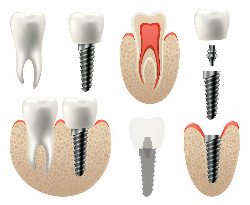 Timespan of a Root Canal Treatment in Whiteville, NC_1