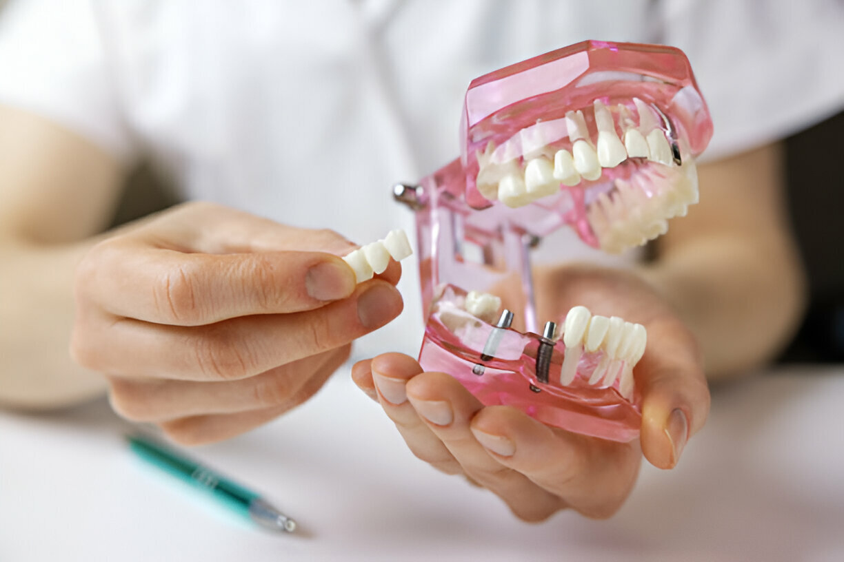 The Ultimate Guide to Dental Implants: Everything You Need to Know_1