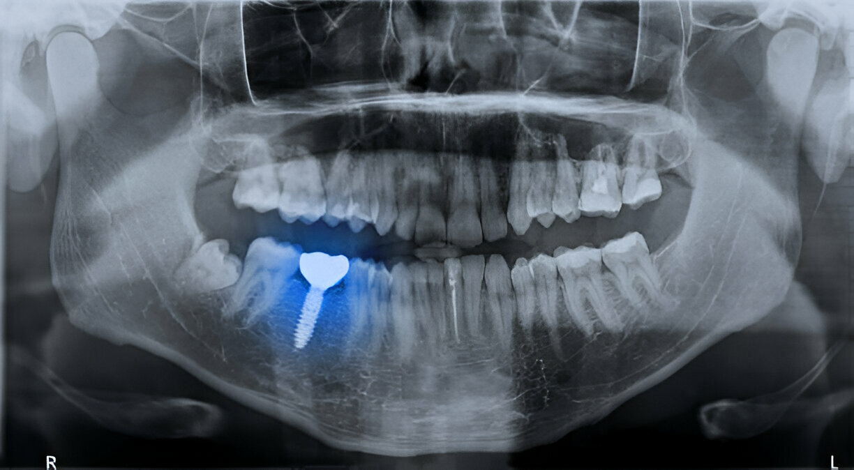 The Ultimate Guide to Dental Implants: Everything You Need to Know_2