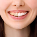 The Ultimate Guide to Teeth-Whitening: Tips and Tricks_FI