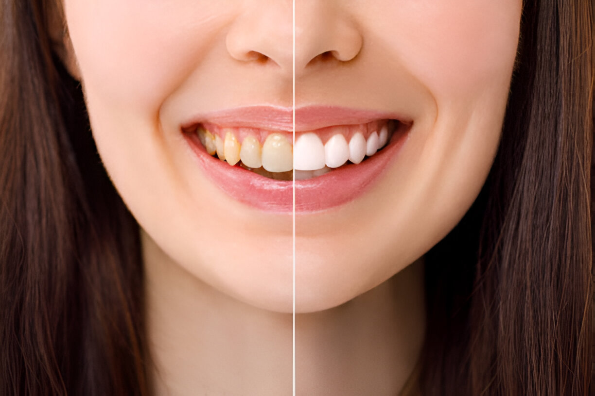 The Ultimate Guide to Teeth-Whitening: Tips and Tricks_FI