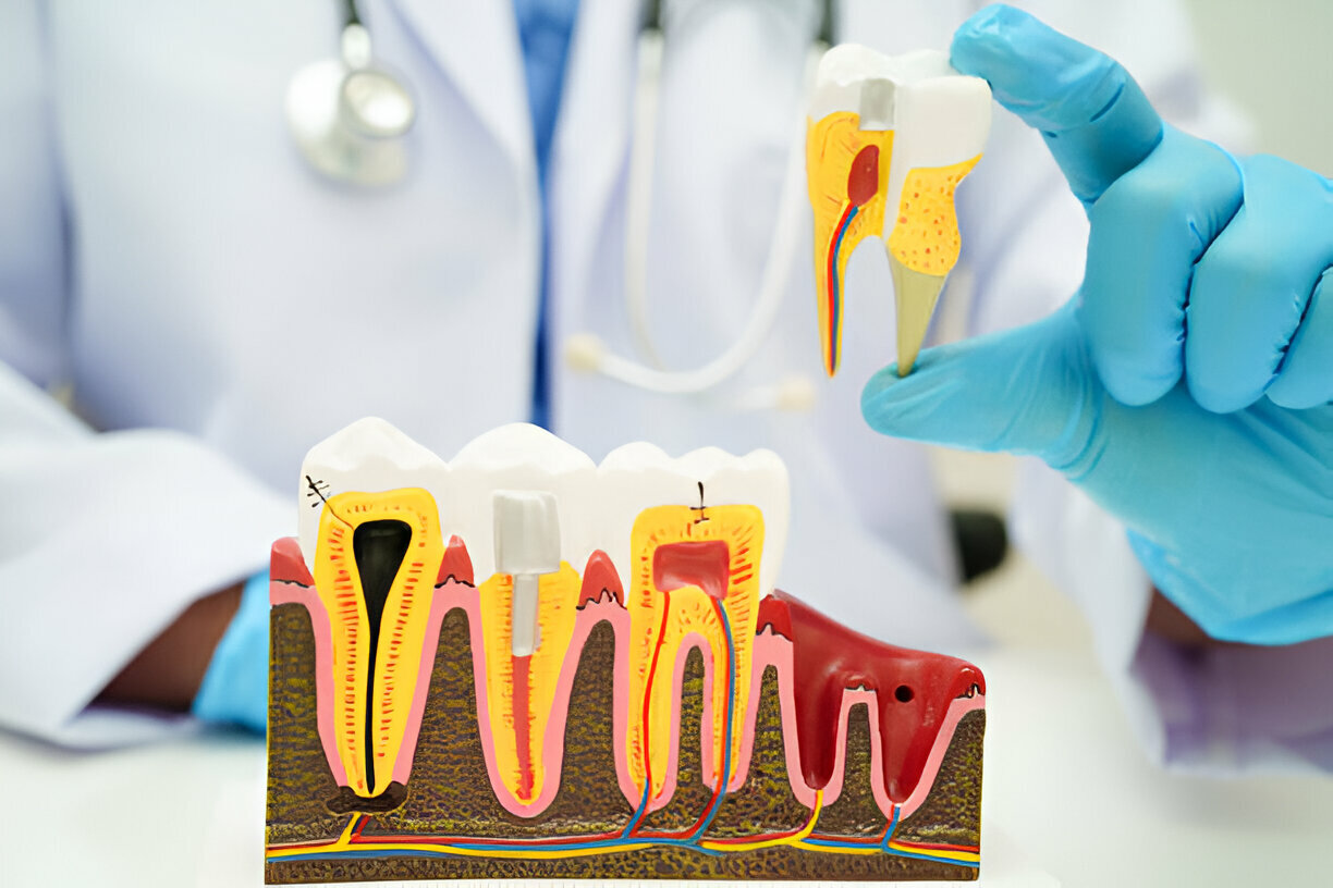 Root Canal Therapy Explained: What to Expect at Carolina Coast Family Dentistry in Shallotte, NC_FI